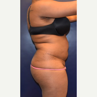 25-34 year old woman treated with Liposuction before 3344479