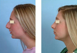 Rhinoplasty before 93645