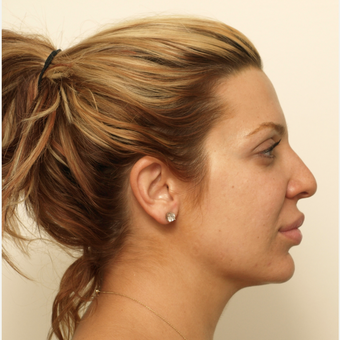 25-34 year old woman treated with Rhinoplasty before 3373418