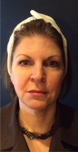 55-64 year old woman treated with Bellafill before 3220354
