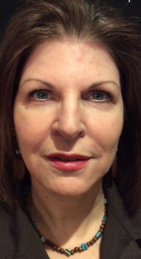 55-64 year old woman treated with Bellafill after 3220354