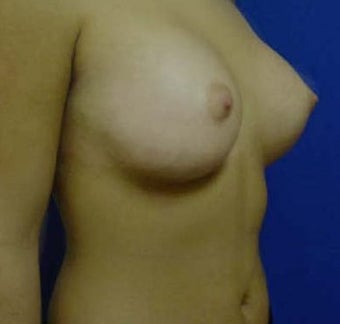 Transaxillary Breast Augmentation 316990