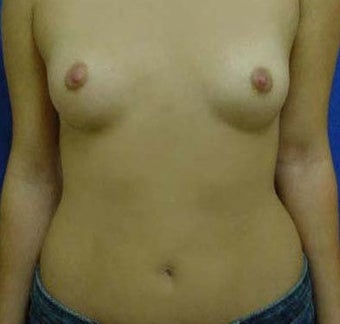 Transaxillary Breast Augmentation before 316990