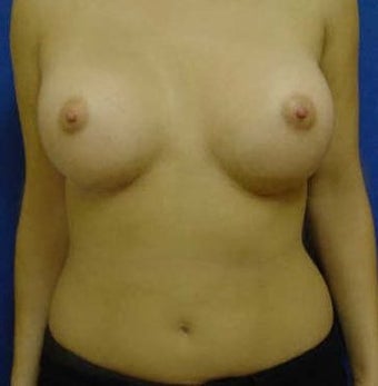 Transaxillary Breast Augmentation after 316990