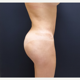 35-44 year old woman treated with 548cc Butt Implants after 3235659