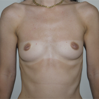 25-34 year old woman treated with Breast Augmentation before 3785079