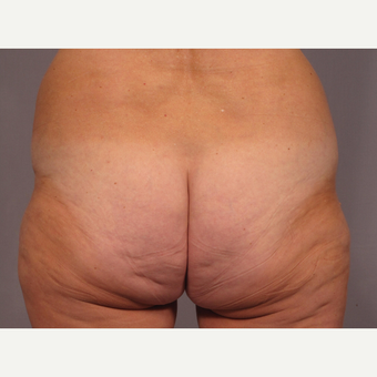 55-64 year old woman treated with Brazilian Butt Lift before 3308488