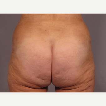 55-64 year old woman treated with Brazilian Butt Lift after 3308488