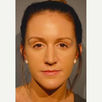 18-24 year old woman treated with Rhinoplasty after 3417482