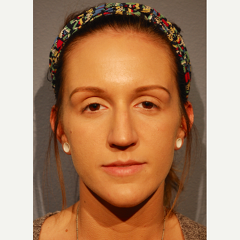 18-24 year old woman treated with Rhinoplasty before 3417482