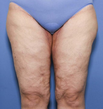 38 year old female treated for thigh laxity following massive weight loss after 943660