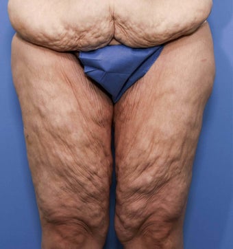 38 year old female treated for thigh laxity following massive weight loss before 943660