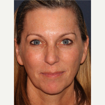 25-34 year old woman treated with Clear & Brilliant Laser Treatment after 3346133