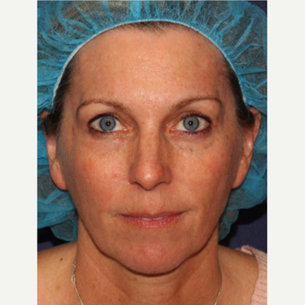 25-34 year old woman treated with Clear & Brilliant Laser Treatment before 3346133