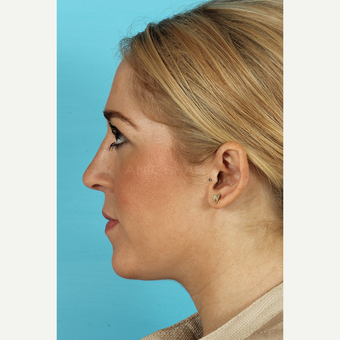 25-34 year old woman treated with Rhinoplasty after 3691161