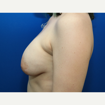 25-34 year old woman treated with Breast Implant Revision before 3104802