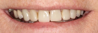 Porcelain Crowns and Porcelain Veneers before 889467