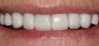 Porcelain Crowns and Porcelain Veneers after 889467