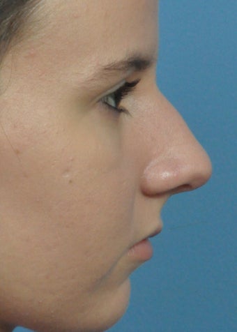 18-24 year old woman treated with Rhinoplasty before 2106946