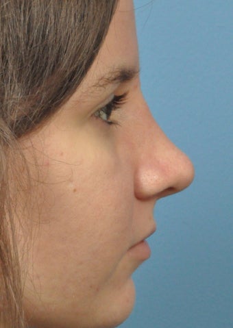 18-24 year old woman treated with Rhinoplasty after 2106946