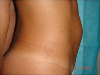 Abdominoplasty Tummy Tuck before 849395