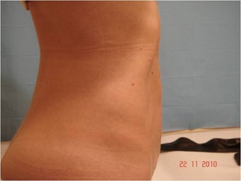 Abdominoplasty Tummy Tuck after 849395