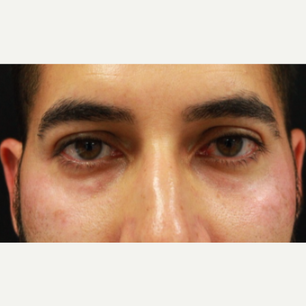38 year old male treated with Belotero injection to tear troughs (undereyes) and forehead lines before 3055263