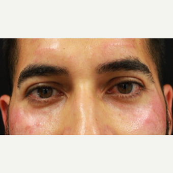 38 year old male treated with Belotero injection to tear troughs (undereyes) and forehead lines after 3055263