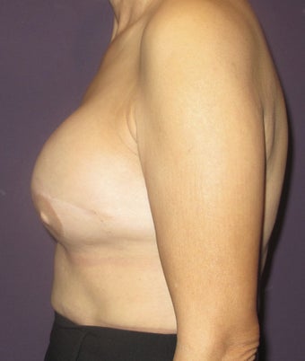 Breast Reconstruction Revision 735298