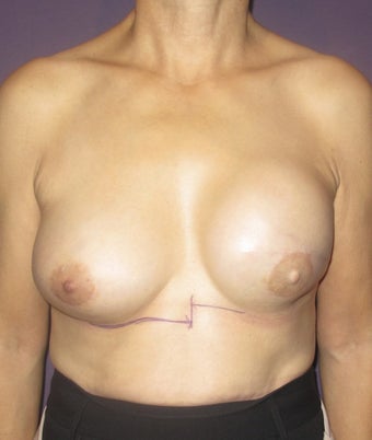 Breast Reconstruction Revision before 735298