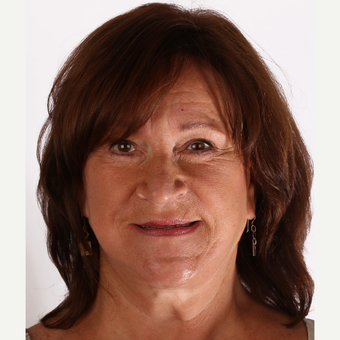 55-64 year old woman treated with Smile Makeover before 3211873