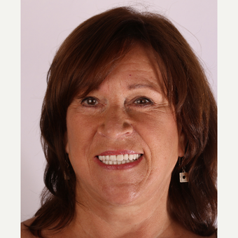 55-64 year old woman treated with Smile Makeover after 3211873