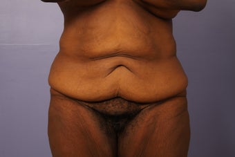 Circumferential Body Lift with Buttocks Augmentation before 1194917