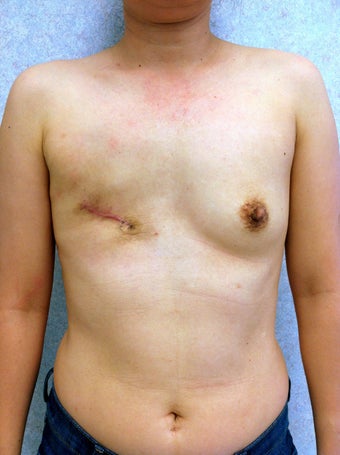 47 Year Old Female underwent breast reconstruction after breast cancer before 1069566