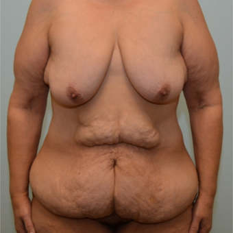 Breast lift, implants, tummy tuck, and excision of excess skin following massive weight loss before 3334031