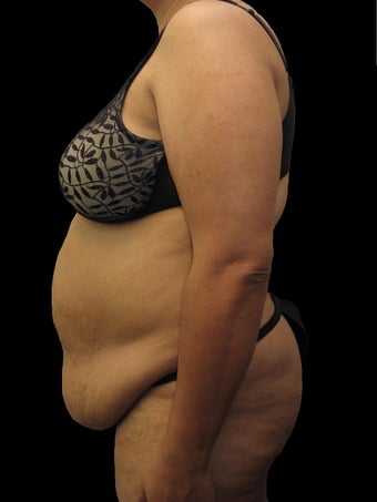43 year old woman treated with Tummy Tuck 3025935