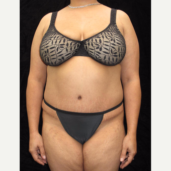 43 year old woman treated with Tummy Tuck after 3025935
