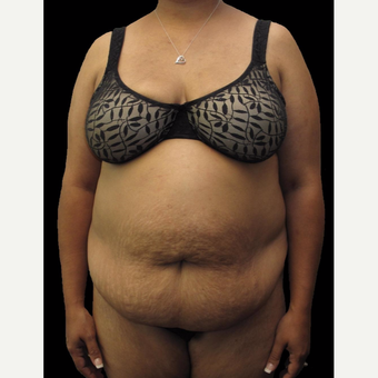 43 year old woman treated with Tummy Tuck before 3025935