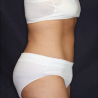 45-54 year old woman treated with Tummy Tuck after 3075303