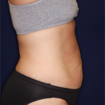 45-54 year old woman treated with Tummy Tuck before 3075303