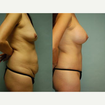 44 year old woman seven months after mommy makeover after 3260977