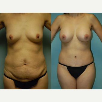 44 year old woman seven months after mommy makeover before 3260977