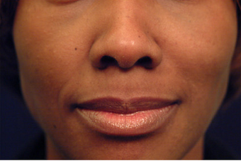 Restylane 82772