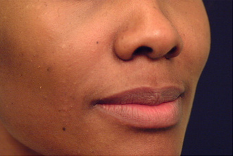 Restylane after 82772