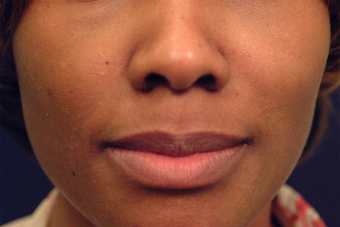Restylane 82772