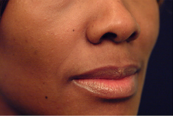 Restylane before 82772