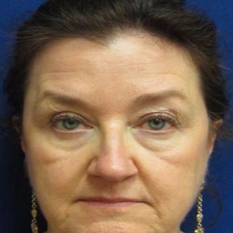 45-54 year old woman treated with Voluma before 1783208