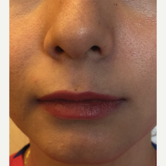 25-34 year old woman treated with Juvederm before 3445556