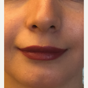 25-34 year old woman treated with Juvederm after 3445556