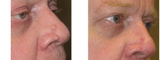 Mole Removal photos before 951894